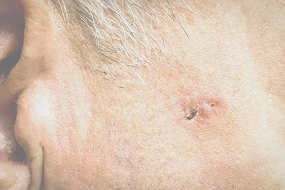 Peggy Chen Skin Cancer and Mohs Surgery Skin Cancer